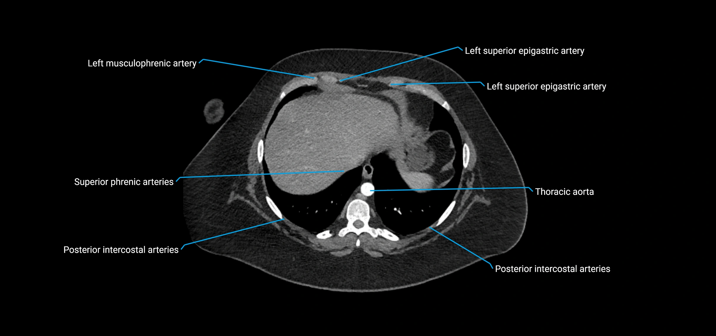 CTA abdomen axial cross sectional anatomy labelled image_18 (1).webp